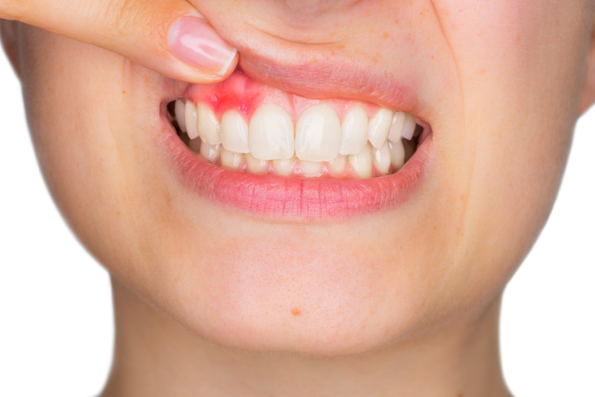 Diş Eti Neden Şişer? Diş Eti Şişmesi Hastalık Belirtisi Midir?   | Minepol