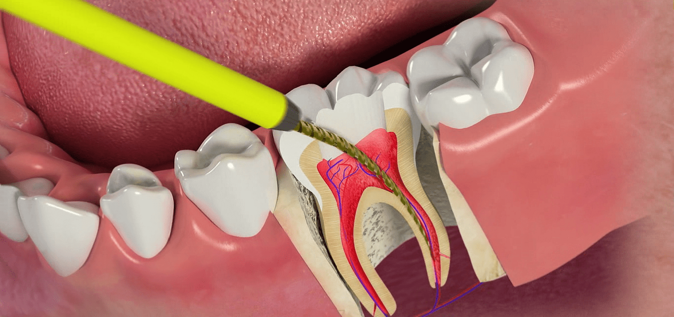 Endodonti (Kanal Tedavisi) | Minepol