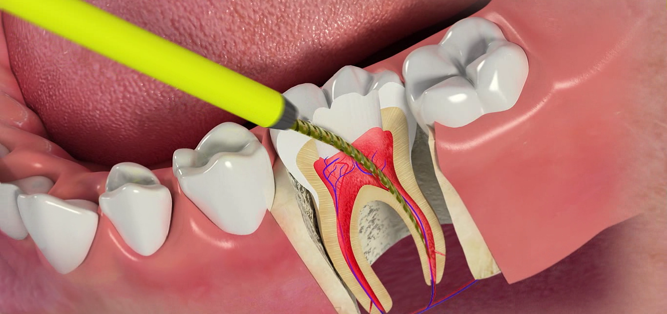 Endodonti (Kanal Tedavisi) | Minepol